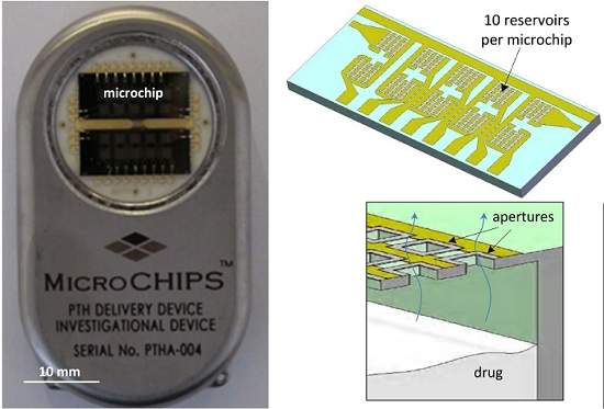 Farmácia implantável: Biochip libera medicamento automaticamente