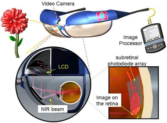 Olho binico a laser usa princpio de clulas solares