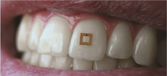 Sensor colado no dente monitora tudo o que voc come ou bebe