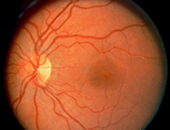 Programa detecta problemas na viso analisando fotografias da retina