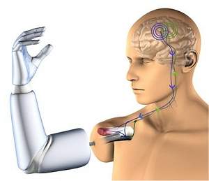 Primeiro implante de uma prótese robótica controlada pelo pensamento