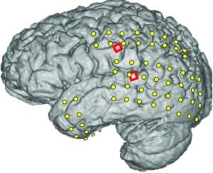 Implante neural converte sinais cerebrais em palavras