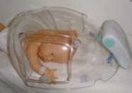 Novo equipamento para tratamento de bebs prematuros