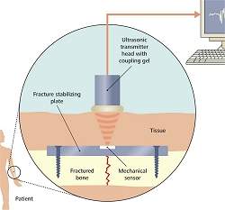 Sensor monitora ossos e implantes sem eletrnica e sem baterias